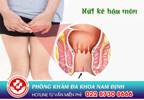nứt kẽ hậu môn