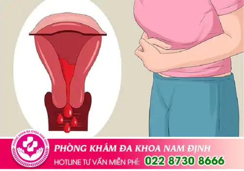 Chảy máu âm đạo
