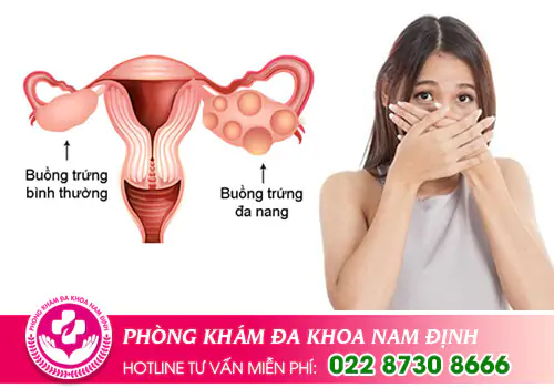 Đa nang buồng trứng