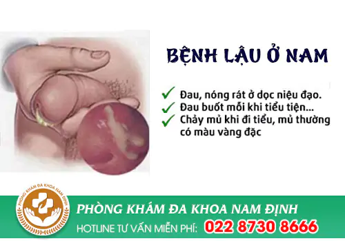 niệu đạo chảy mủ là dấu hiệu của bệnh lậu