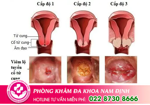 Dấu hiệu viêm lộ tuyến tử cung